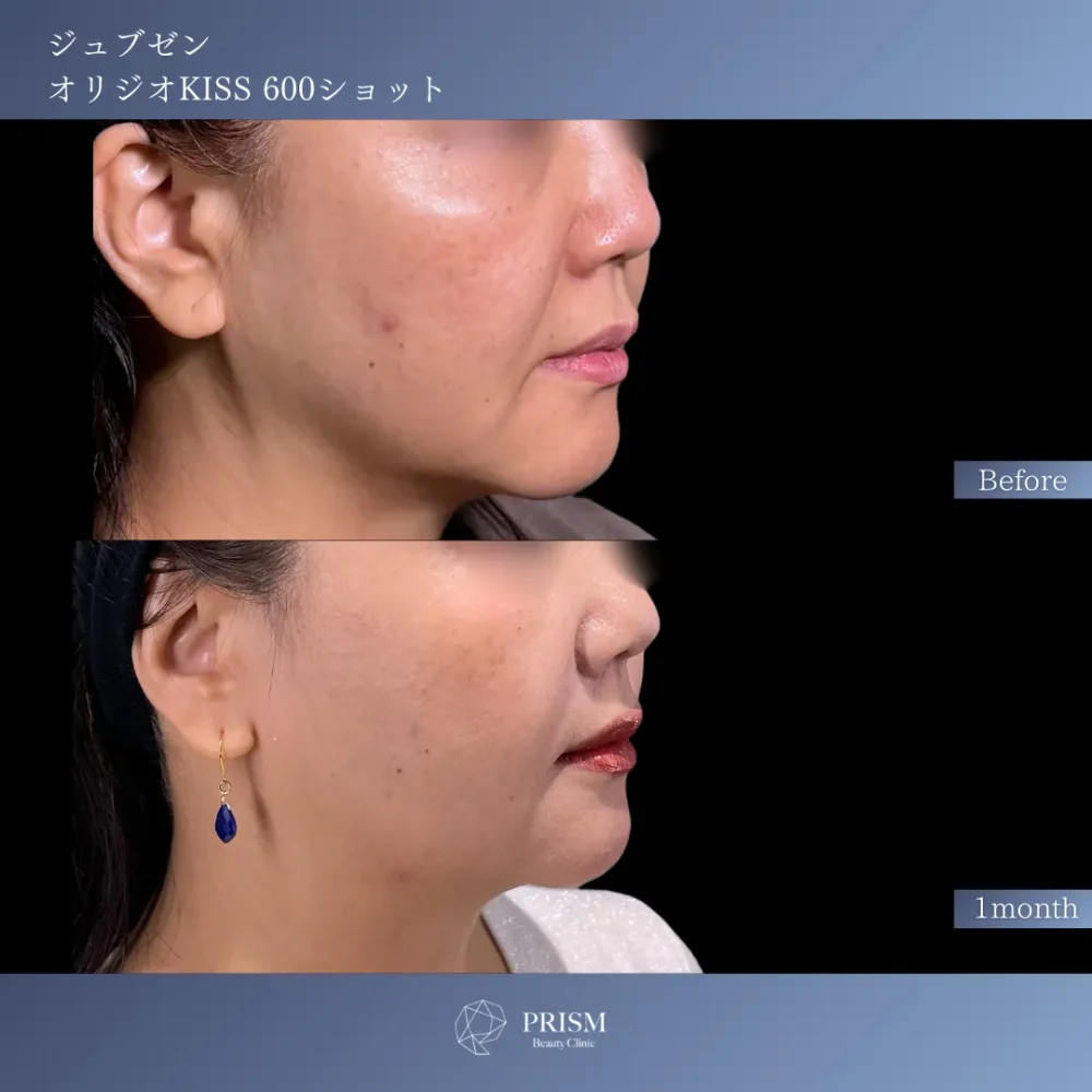 ジュブゼン（ほうれい線）