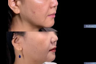 ジュブゼン（ほうれい線）