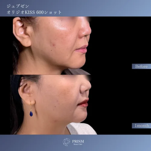 ジュブゼン（ほうれい線）