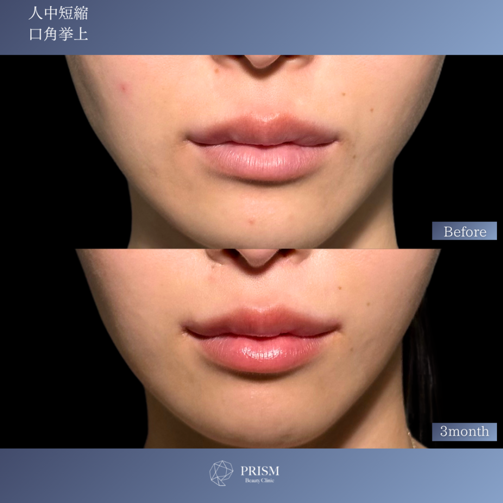 人中短縮＋口角挙上