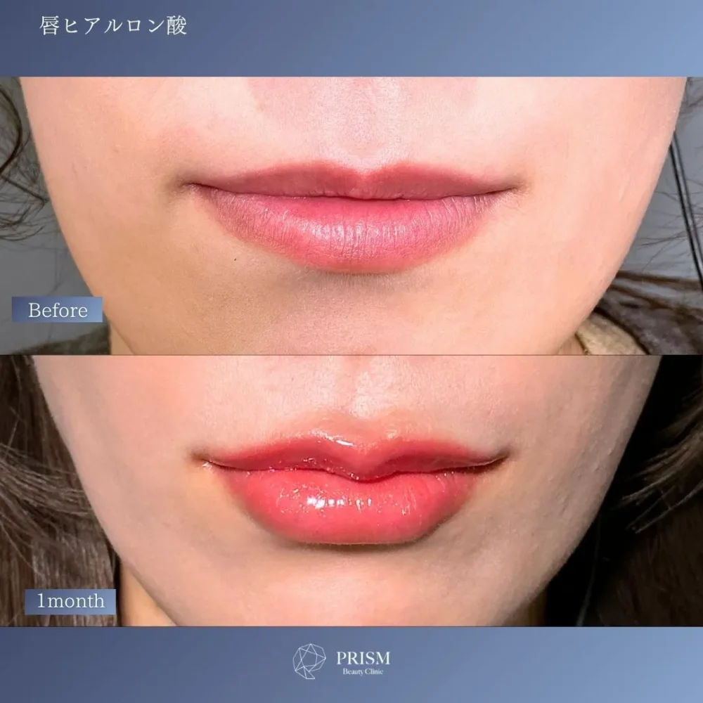ヒアルロン酸（唇）