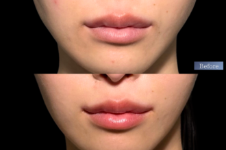 人中短縮＋口角挙上