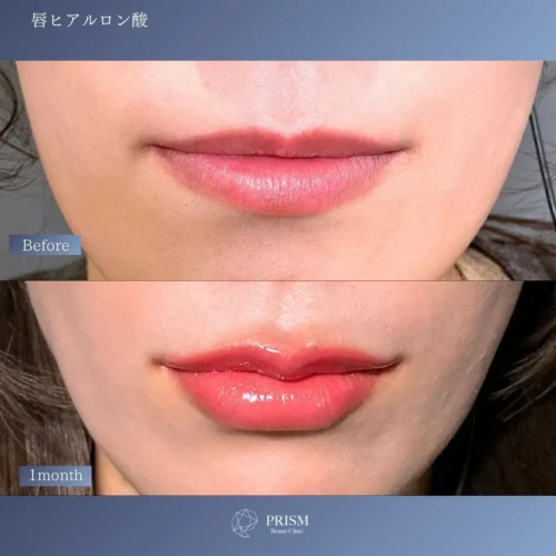 ヒアルロン酸(唇) ヒアルロン酸(唇)