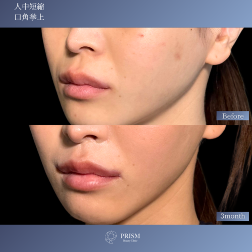 人中短縮+口角挙上 人中短縮+口角挙上