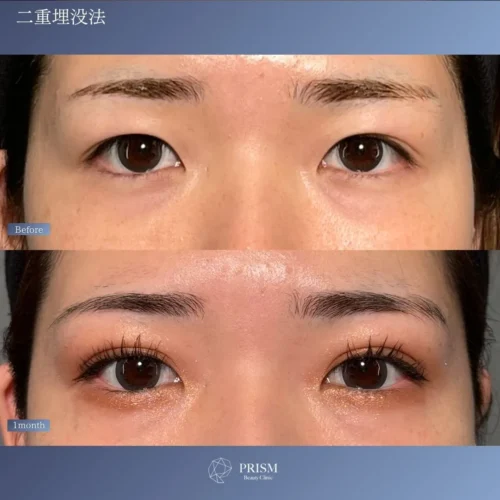 PRISM 1day二重埋没 プレミアムプラス 線留め (自然癒着法)