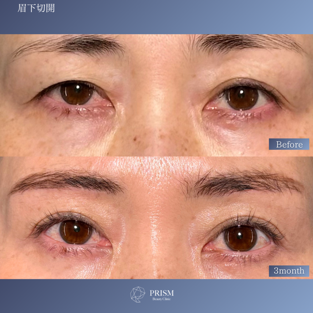眉下リフト
