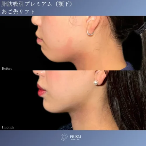 エルサ脂肪吸引プレミアム（顎下）＋あご先リフト