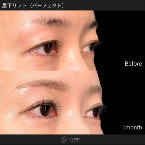 眉下リフト 眉下リフト
