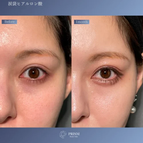 ヒアルロン酸（涙袋）