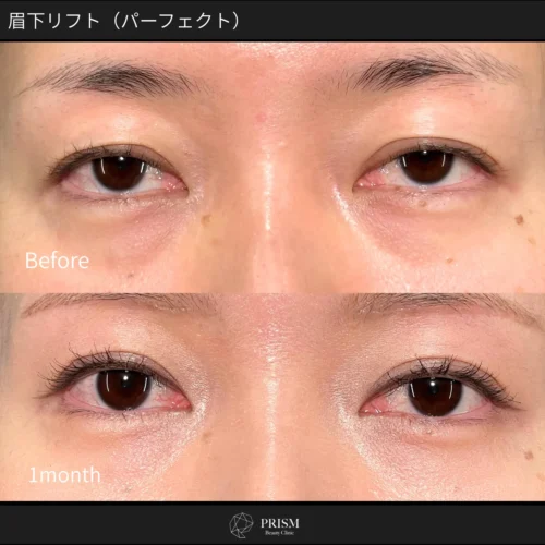 眉下リフト