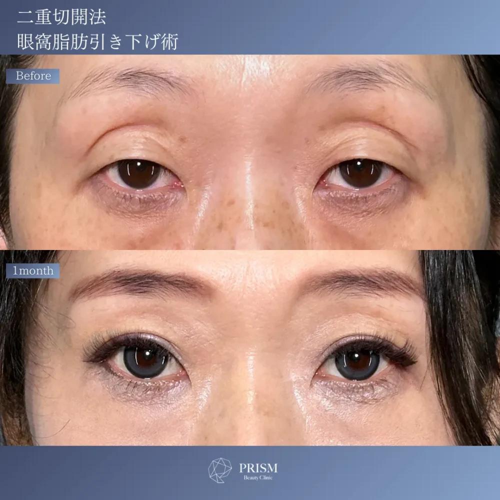 二重切開法(眼窩脂肪引き下げ術)