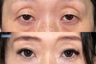 二重切開法(眼窩脂肪引き下げ術)