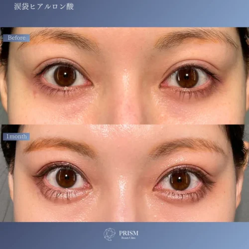 ヒアルロン酸（涙袋）