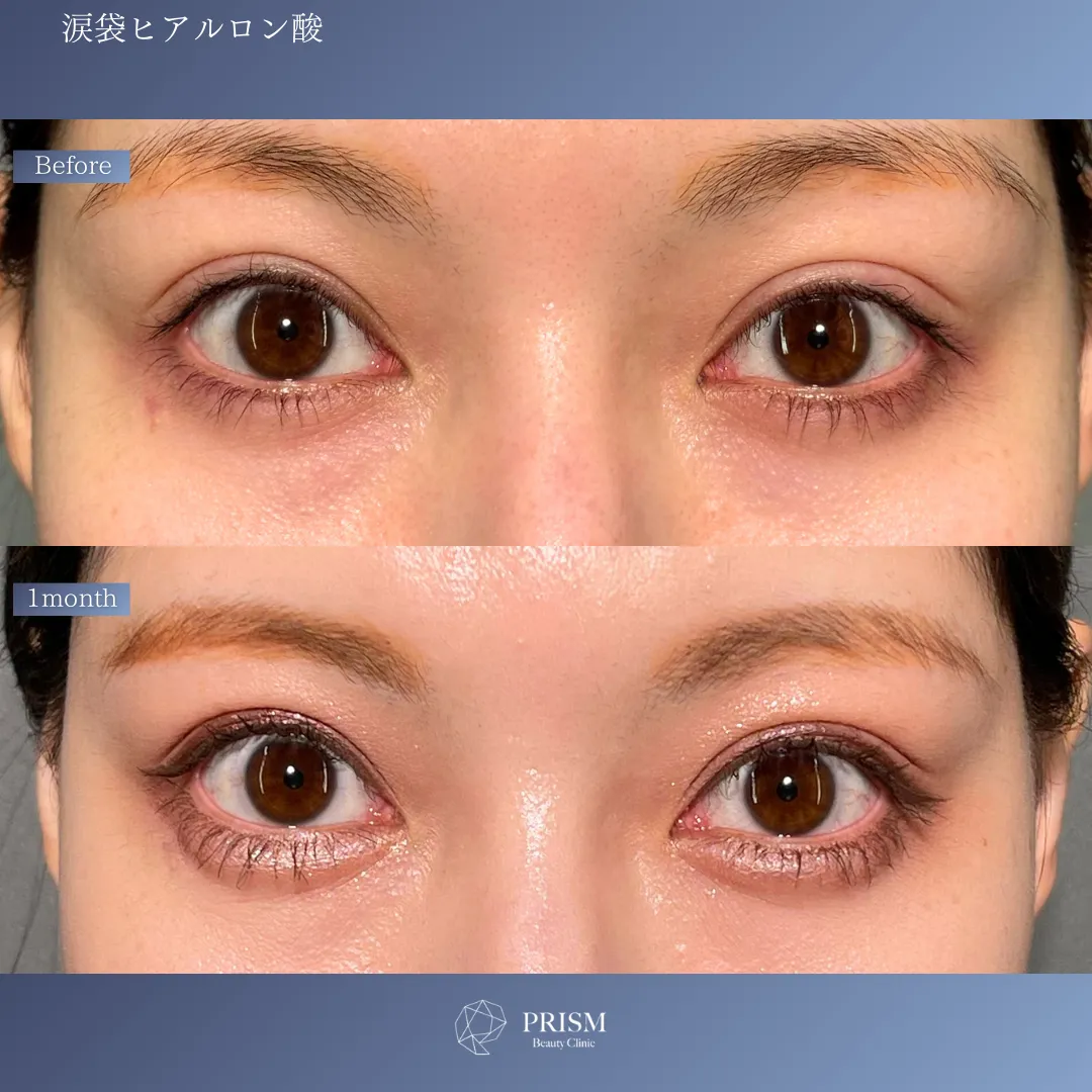 ヒアルロン酸注射 < 新宿・町田の美容外科・美容皮膚科｜PRISM Beauty