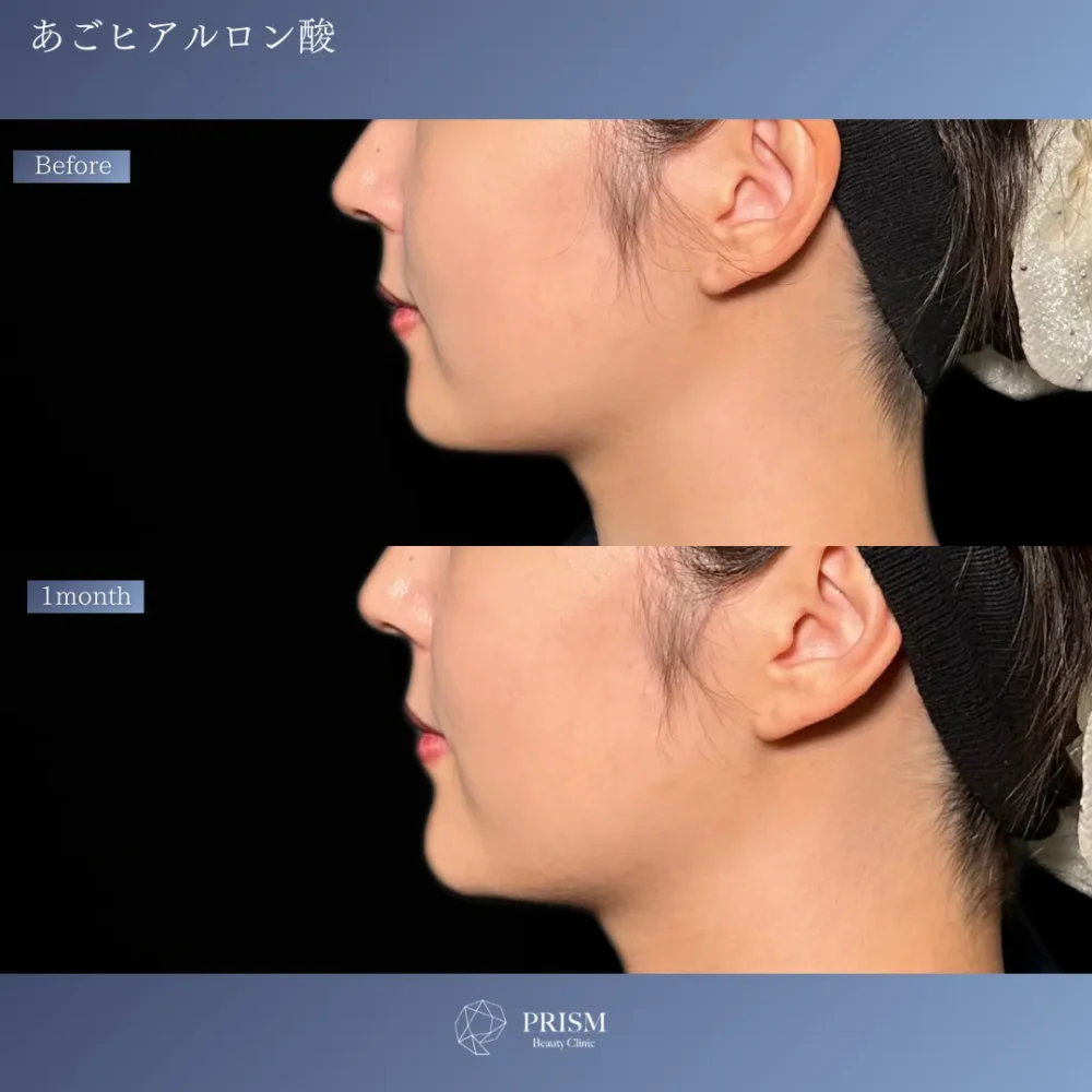 ヒアルロン酸（あご）