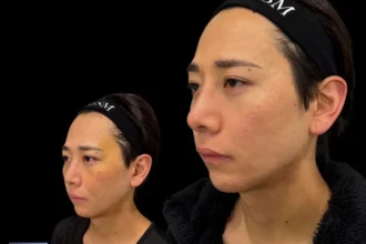 鼻翼挙上＋鼻柱降下（耳介軟骨移植）＋鼻中隔延長（耳介軟骨移植）＋鼻先リフト（オープン法）＋鼻プロテーゼ