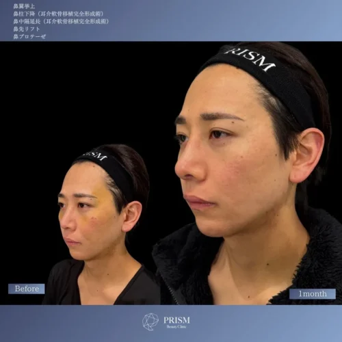 鼻翼挙上＋鼻柱降下（耳介軟骨移植）＋鼻中隔延長（耳介軟骨移植）＋鼻先リフト（オープン法）＋鼻プロテーゼ