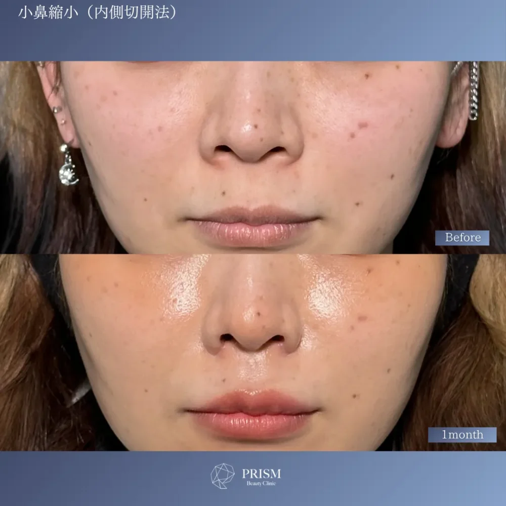 小鼻縮小（鼻翼縮小） 内側切開法