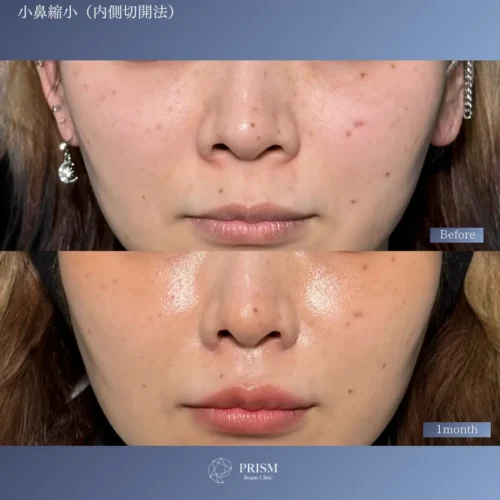 小鼻縮小（鼻翼縮小） 内側切開法