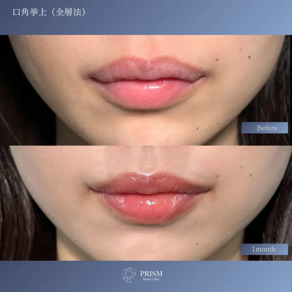 口角挙上（全層法）