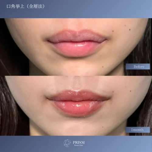 口角挙上（全層法）