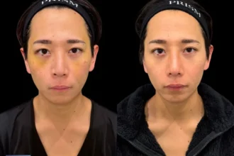 鼻翼挙上＋鼻柱降下（耳介軟骨移植）＋鼻中隔延長（耳介軟骨移植）＋鼻先リフト（オープン法）＋鼻プロテーゼ