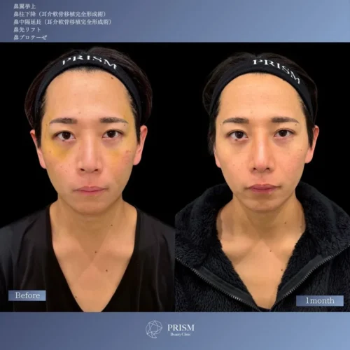 鼻翼挙上＋鼻柱降下（耳介軟骨移植）＋鼻中隔延長（耳介軟骨移植）＋鼻先リフト（オープン法）＋鼻プロテーゼ