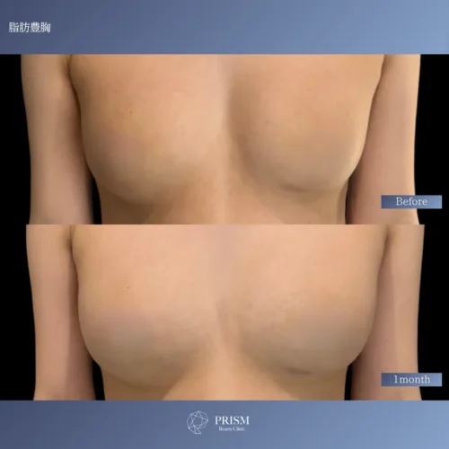 脂肪豊胸(脂肪注入豊胸) 脂肪豊胸(脂肪注入豊胸)